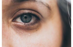 Pourquoi a-t-on des cernes quand on est fatigué ?