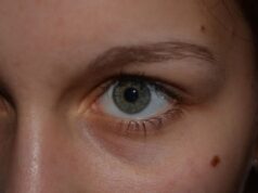 Quand s’inquiéter de ses grains de beauté ?
