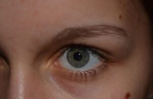 Quand s’inquiéter de ses grains de beauté ?