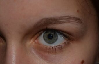 Quand s’inquiéter de ses grains de beauté ?