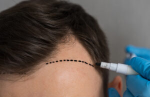 Greffe de cheveux en Turquie : pourquoi le pays attire-t-il autant ?