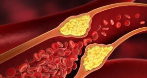 Rupture d’anévrisme : ces signes à ne pas négliger