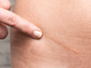 Comment soigner et effacer une cicatrice d’une manière efficace ?