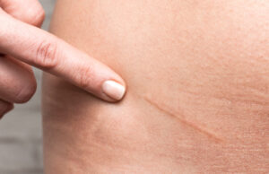 Comment soigner et effacer une cicatrice d’une manière efficace ?