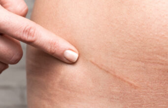 Comment soigner et effacer une cicatrice d’une manière efficace ?