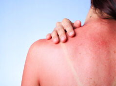 Coups de soleil : 5 astuces naturelles pour les soulager