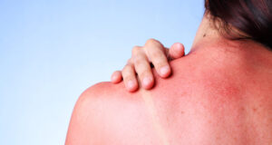 Coups de soleil : 5 astuces naturelles pour les soulager