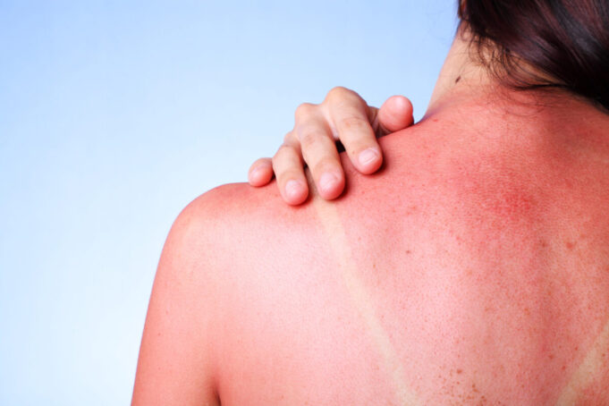Coups de soleil : 5 astuces naturelles pour les soulager