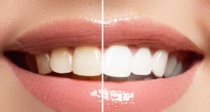 Ces 7 aliments à éviter pour garder les dents blanches