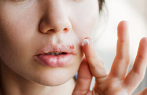 Comment soigner un bouton de fièvre ?