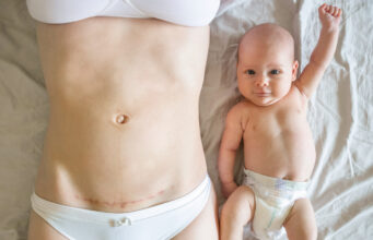 Naissance : quel est l’effet de la césarienne sur le microbiote de bébé ?