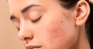 Ces 6 aliments sont mauvais pour la peau, évitez les