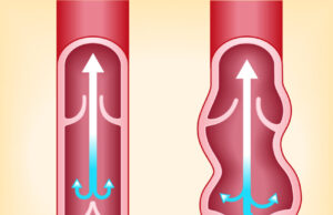 Jambes lourdes : évitez ces 5 aliments pour les soulager