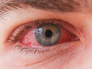 5 remèdes naturels et efficaces en cas de conjonctivite !