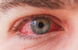 5 remèdes naturels et efficaces en cas de conjonctivite !