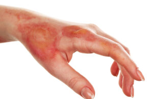 Brûlures : utilisez ces huiles essentielles pour les guérir