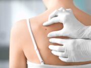 Cancer : Savoir reconnaître les changements inquiétants des grains de beauté