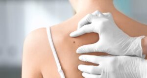 Cancer : Savoir reconnaître les changements inquiétants des grains de beauté