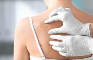 Cancer : Savoir reconnaître les changements inquiétants des grains de beauté