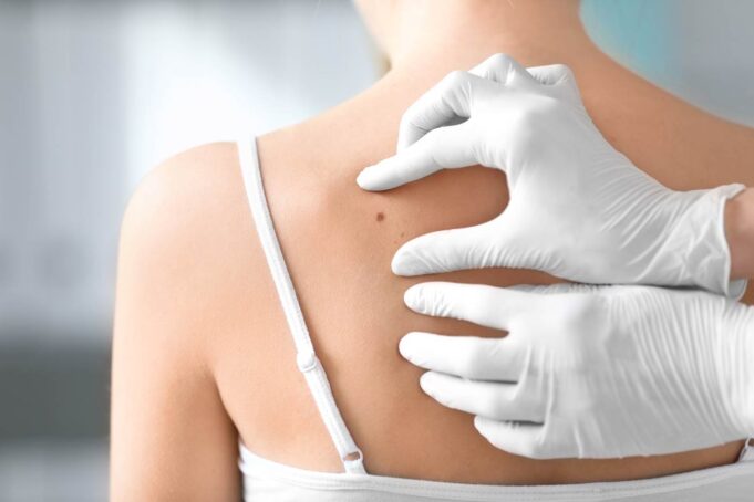 Cancer : Savoir reconnaître les changements inquiétants des grains de beauté