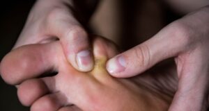 5 remèdes naturels pour soigner les cors aux pieds douloureux