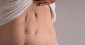Ablation de l’utérus : les avantages et les inconvénients de l’hystérectomie