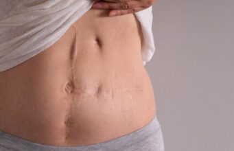 Ablation de l’utérus : les avantages et les inconvénients de l’hystérectomie