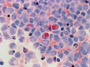 Cancer : un nouveau médicament capable d’éradiquer les tumeurs