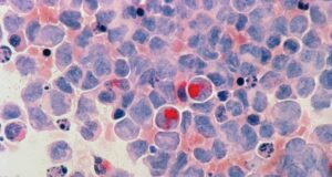 Cancer : un nouveau médicament capable d’éradiquer les tumeurs