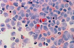 Cancer : un nouveau médicament capable d’éradiquer les tumeurs