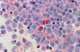 Cancer : un nouveau médicament capable d’éradiquer les tumeurs