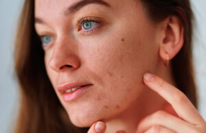 L’acné est bonne pour la santé, affirme une étude