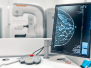 Cancer du sein : la mammographie à reculons