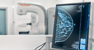 Cancer du sein : la mammographie à reculons