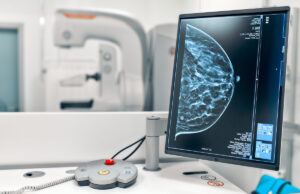 Cancer du sein : la mammographie à reculons