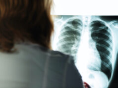 Embolie pulmonaire : les premiers signes à reconnaître qui doivent vous inquiéter