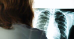 Embolie pulmonaire : les premiers signes à reconnaître qui doivent vous inquiéter