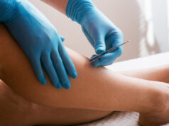 Poils incarnés : les solutions naturelles pour en venir à bout