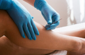 Poils incarnés : les solutions naturelles pour en venir à bout