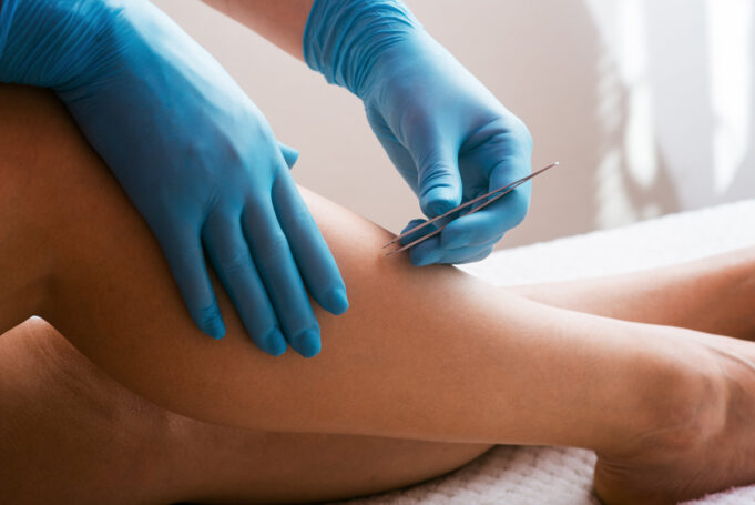 Poils incarnés : les solutions naturelles pour en venir à bout