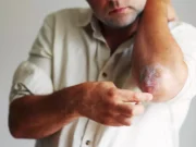 Plaques rouges sur le corps ? Et si c’était le psoriasis ?