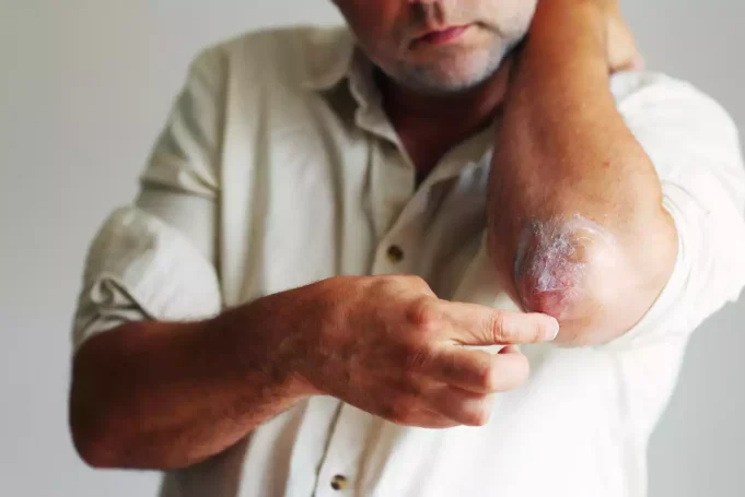 Plaques rouges sur le corps ? Et si c’était le psoriasis ?