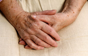 Comment faire disparaître les taches de vieillesse sur la peau ?