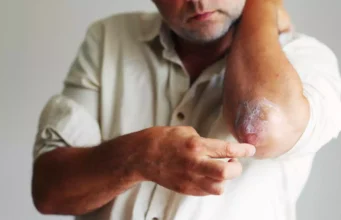 Plaques rouges sur le corps ? Et si c’était le psoriasis ?