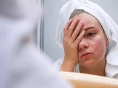 Acné sévère : un nouveau traitement réduit de 50% les symptômes