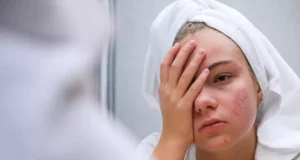 Acné sévère : un nouveau traitement réduit de 50% les symptômes