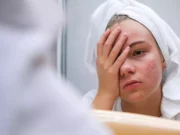 Acné sévère : un nouveau traitement réduit de 50% les symptômes