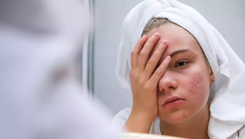 Acné sévère : un nouveau traitement réduit de 50% les symptômes