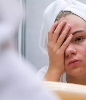 Acné sévère : un nouveau traitement réduit de 50% les symptômes