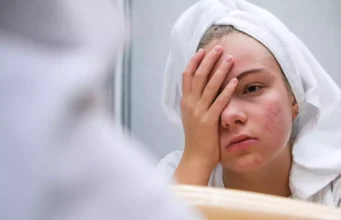 Acné sévère : un nouveau traitement réduit de 50% les symptômes